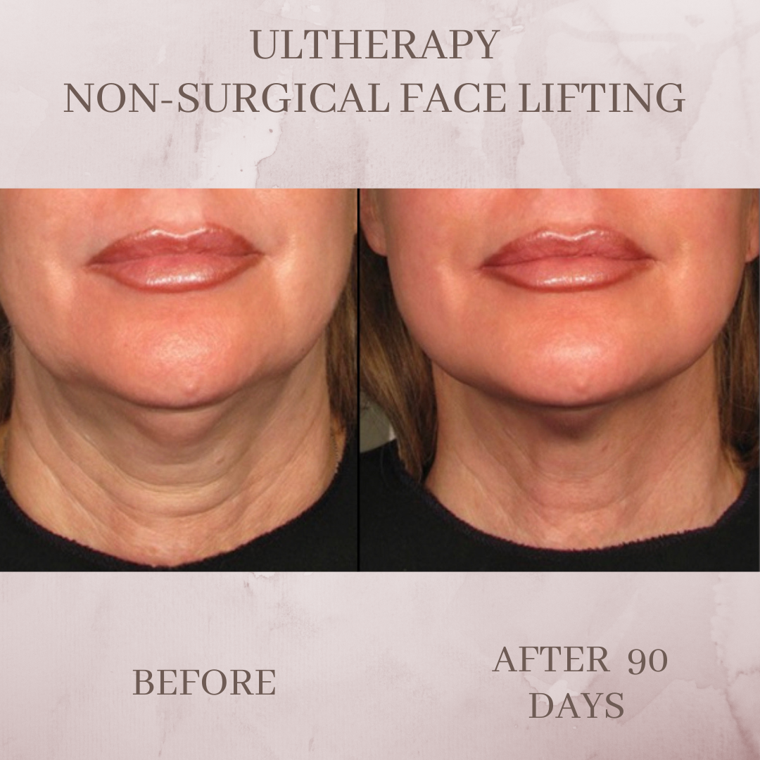 Ultherapy neck before and after Jacksonville Florida