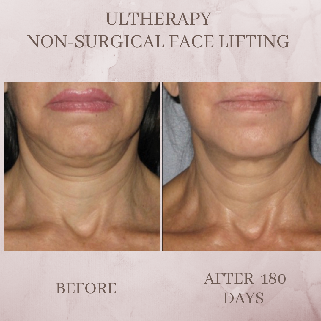 Ultherapy neck before and after Jacksonville Florida