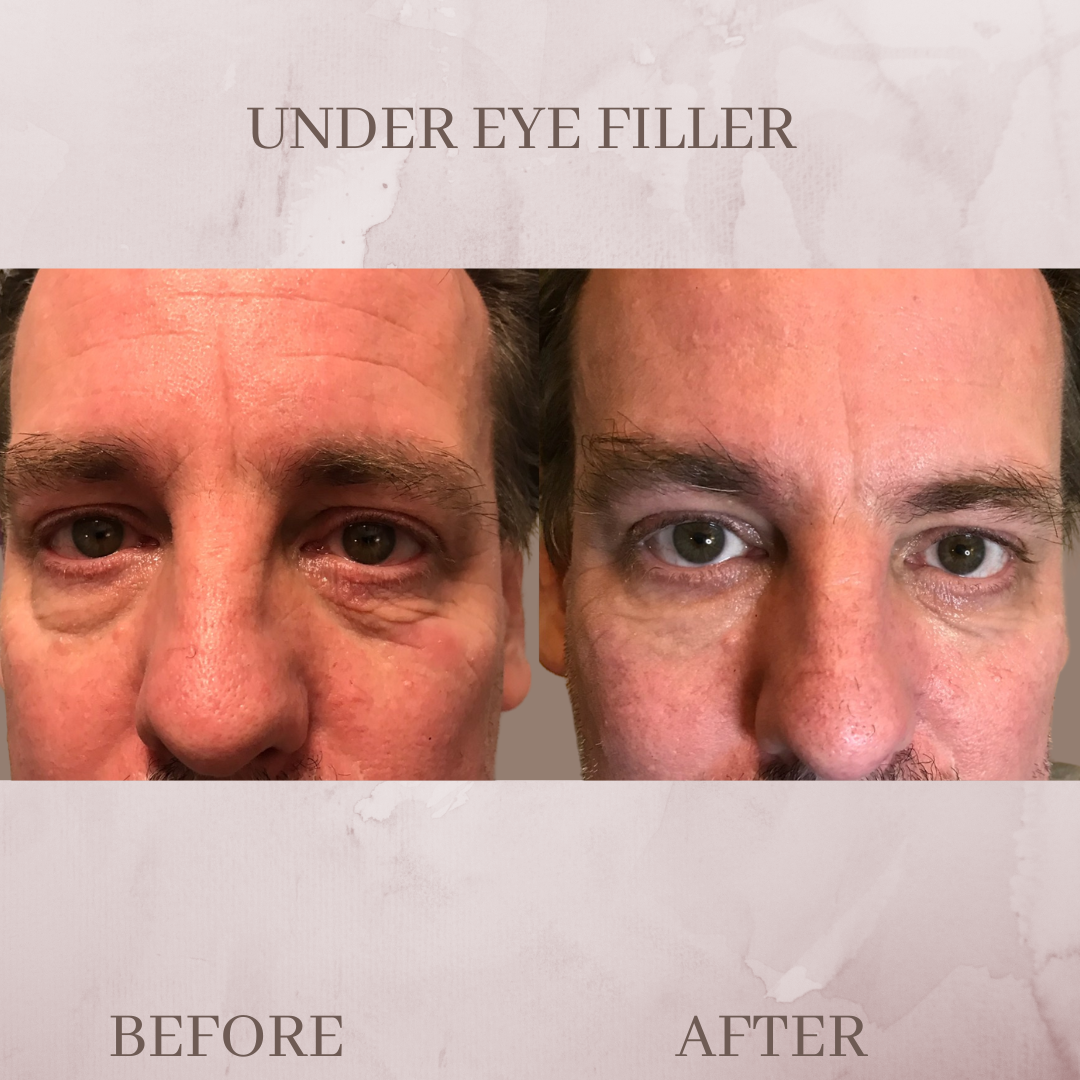 Under Eye Filler before and after