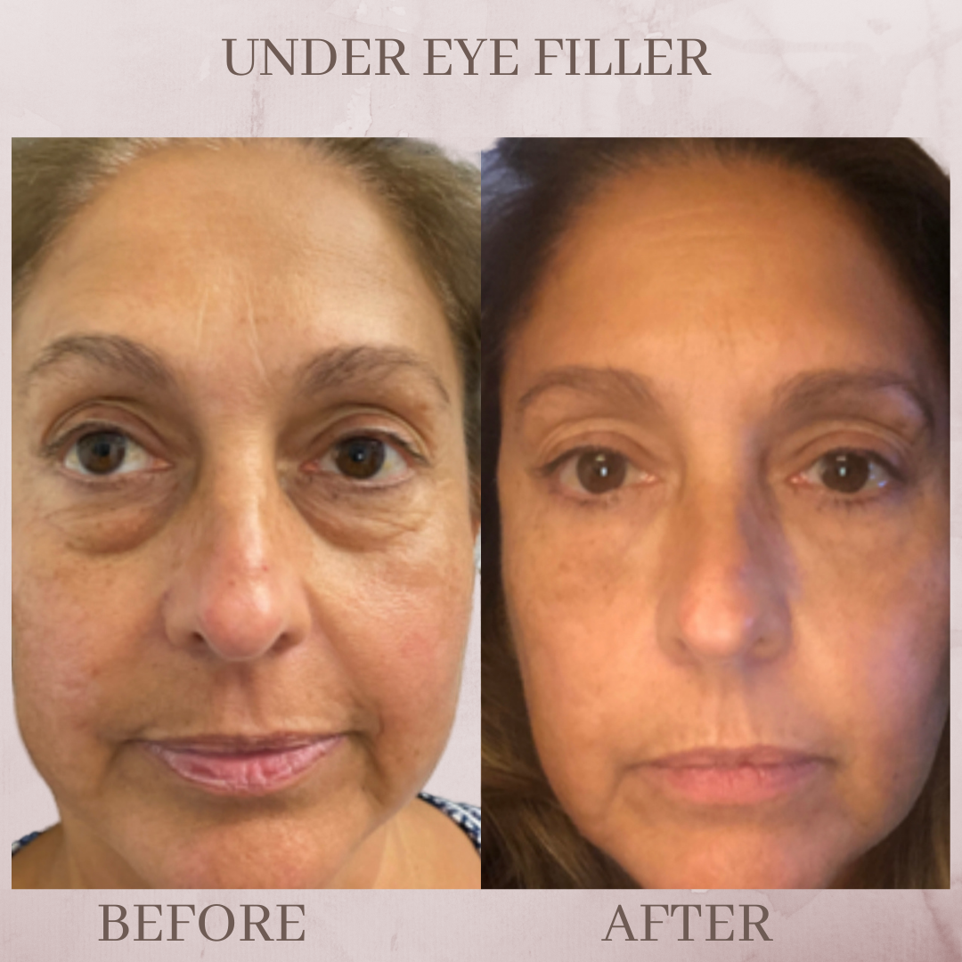 Under Eye Filler before and after