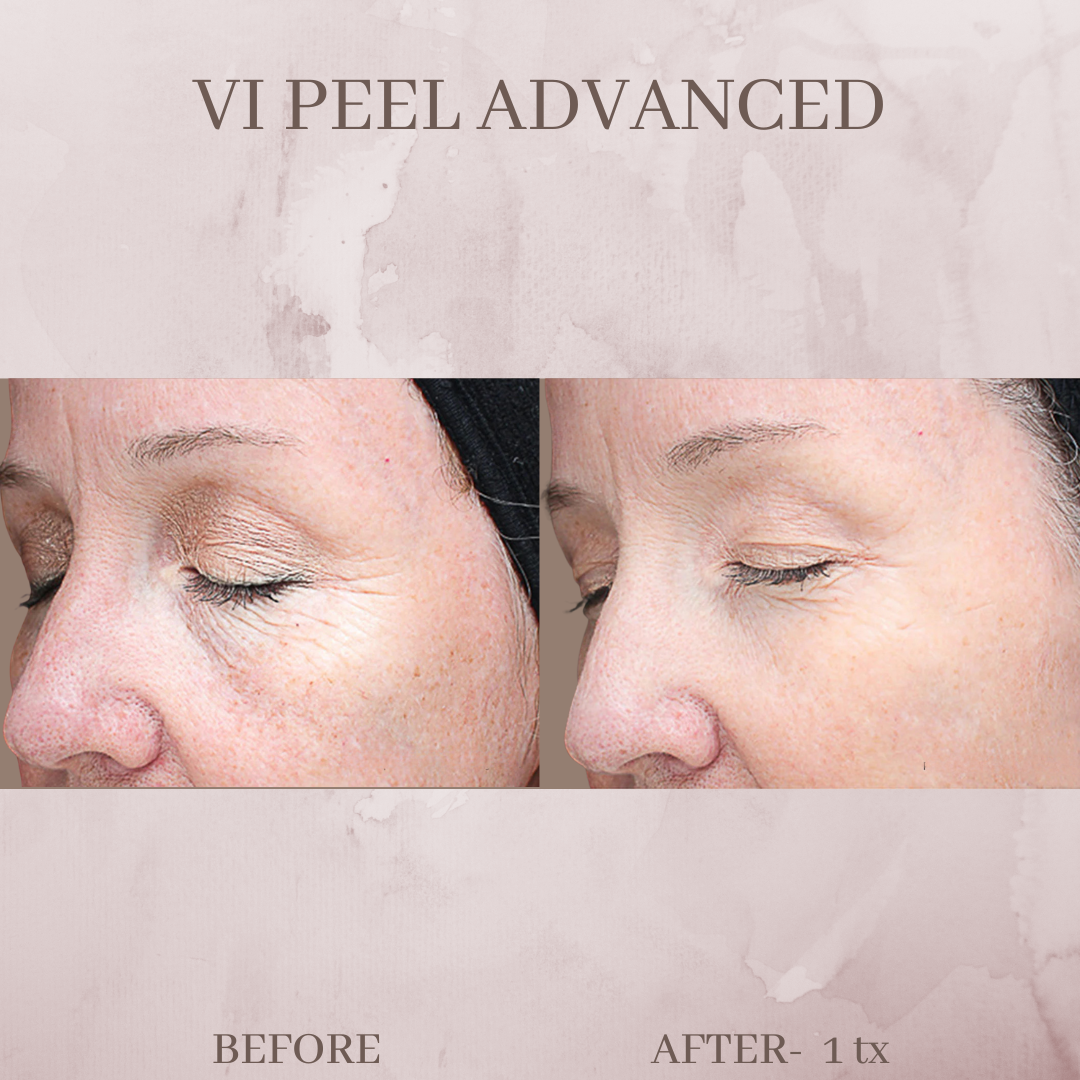 VII PEEL before and after jacksonville fl