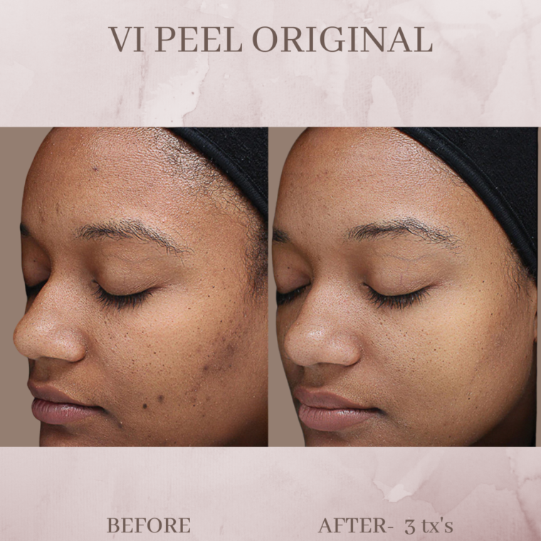 Vi Peel Eluma Laser And Aesthetics 4428