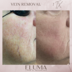 Laser facial vein removal before and after Jacksonville Florida