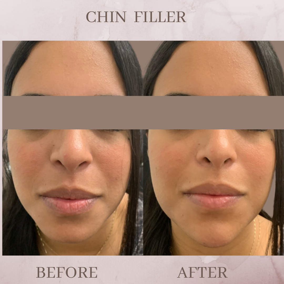 chin filler before and after jacksonville fl