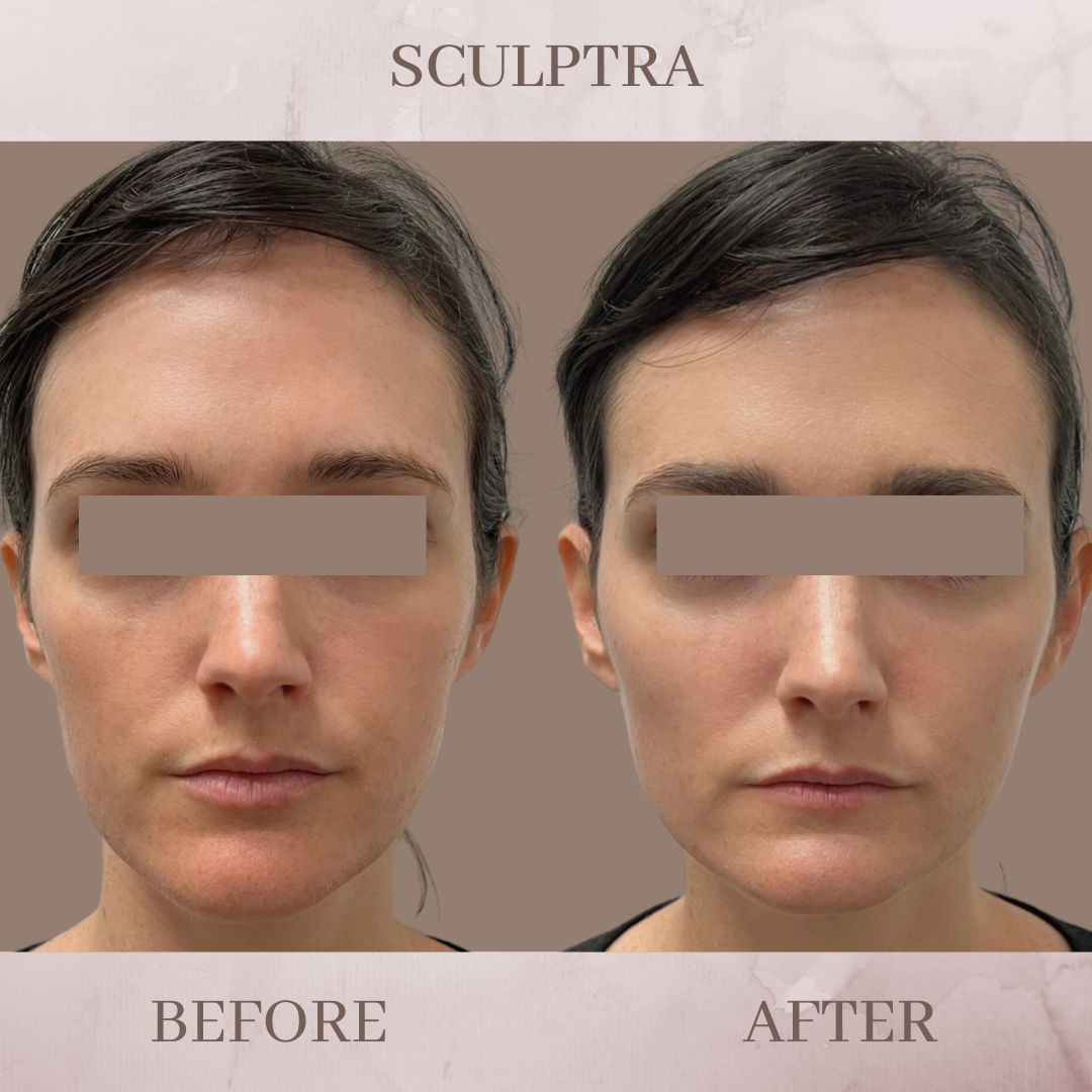 Sculptra Eluma Laser Aesthetics