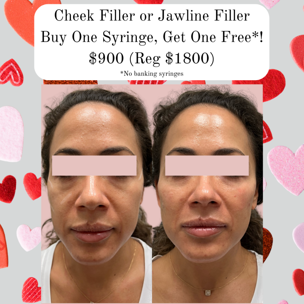 Juvederm voluma cheek filler. Volux cheek filler buy one get one free.