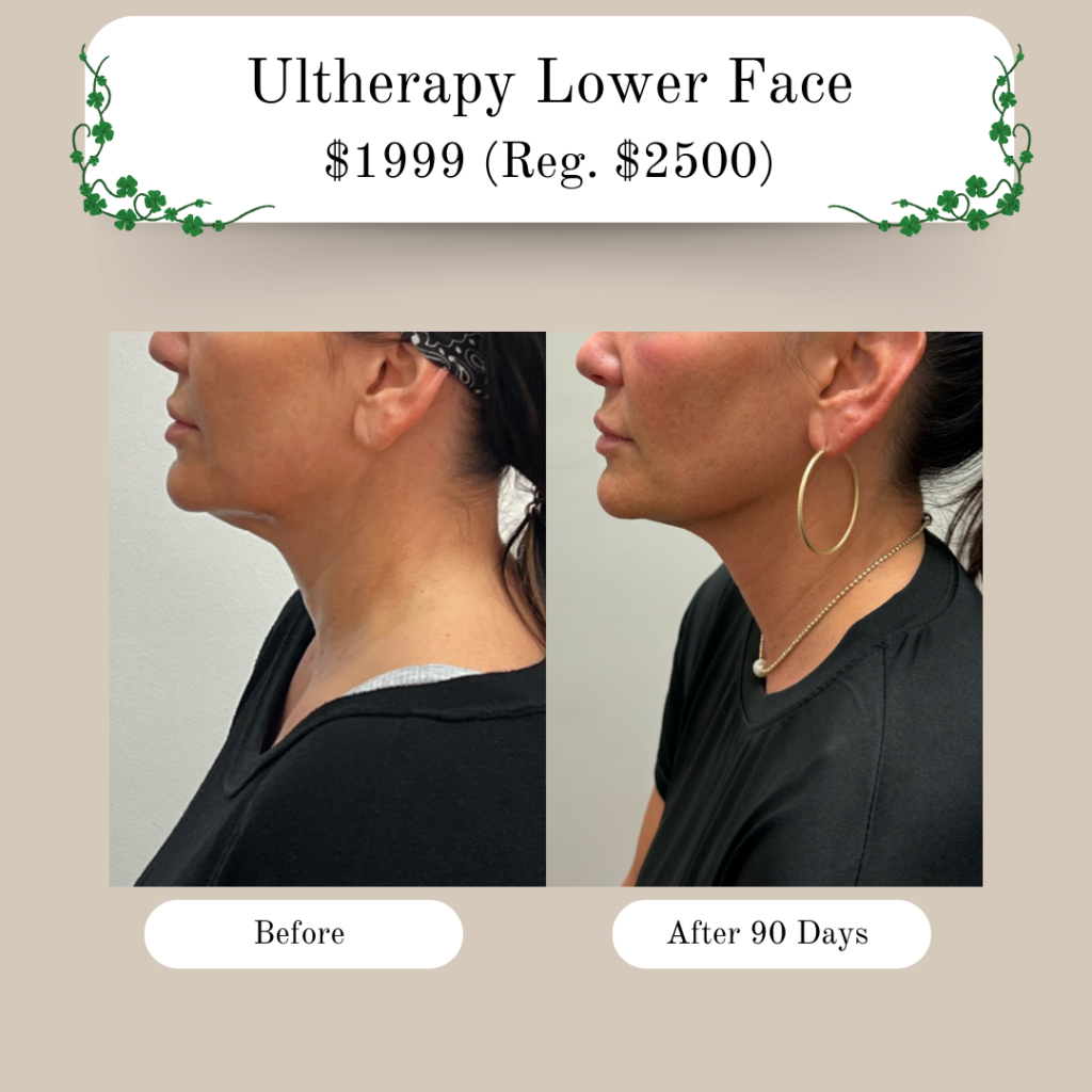 Lower face tightening without surgery. Ultherapy lower face lift.