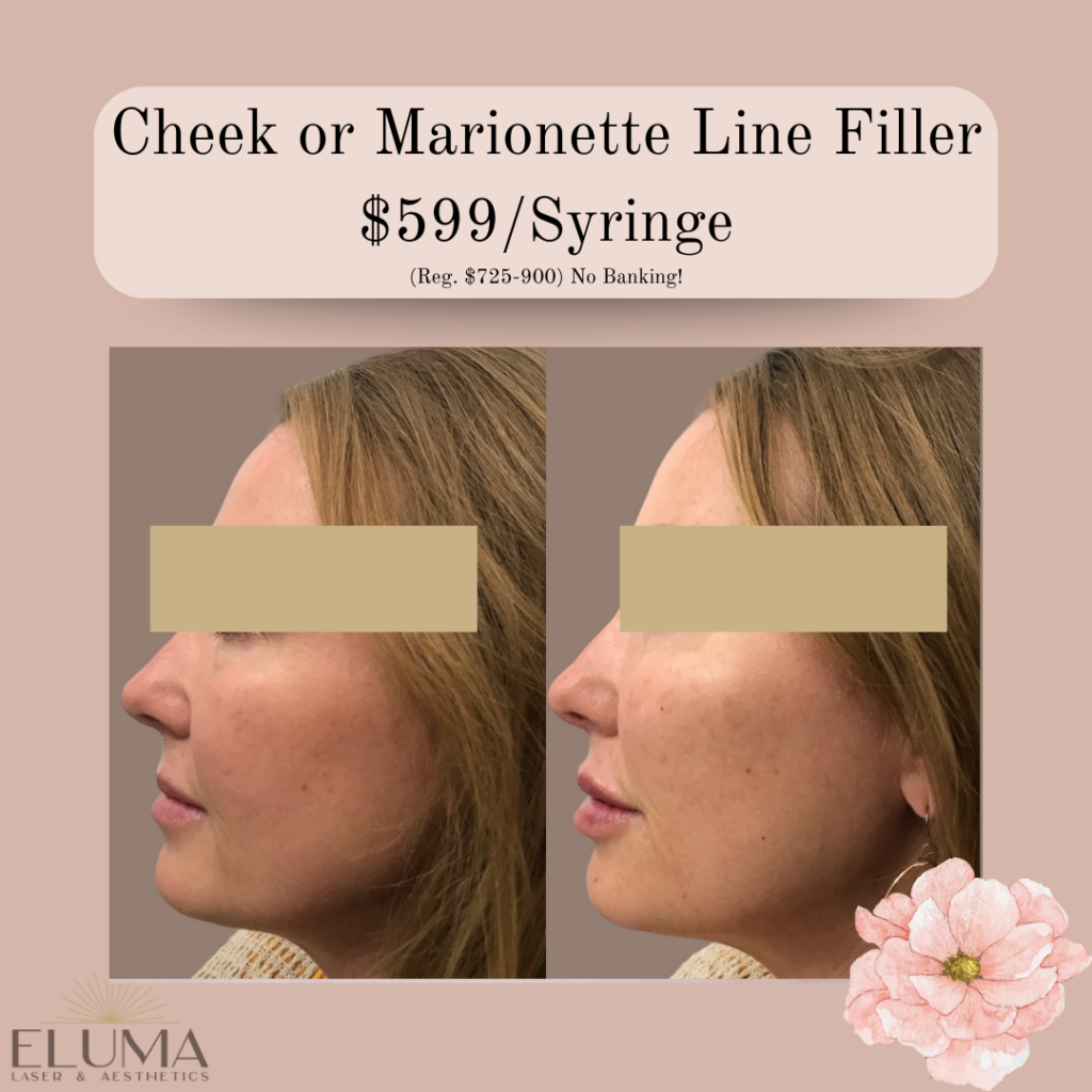 May Specials Cheek or marionette filler Eluma Laser and Aesthetics - Eluma - Laser & Aesthetics