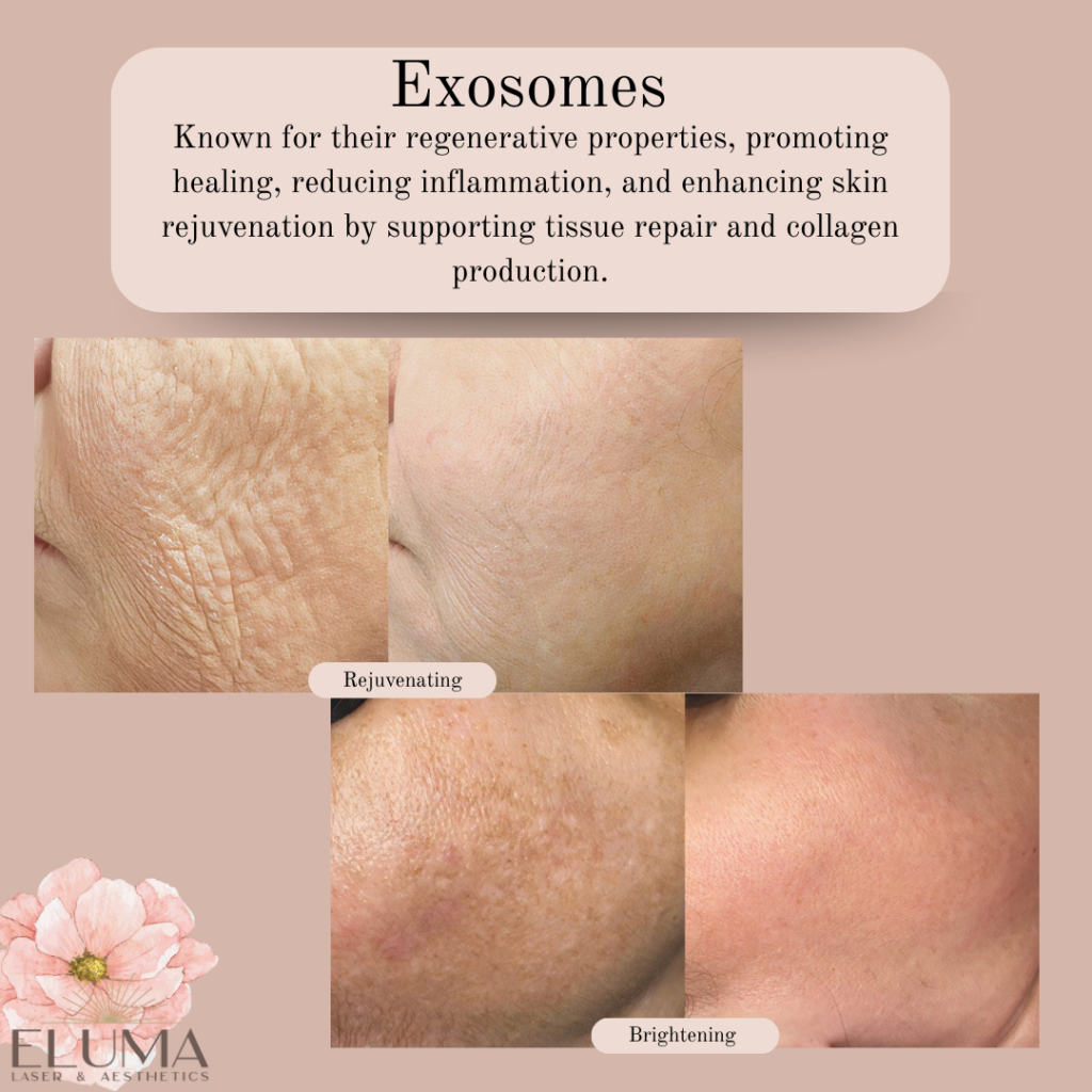 May Specials Exosomes Eluma Laser and Aesthetics - Eluma - Laser & Aesthetics