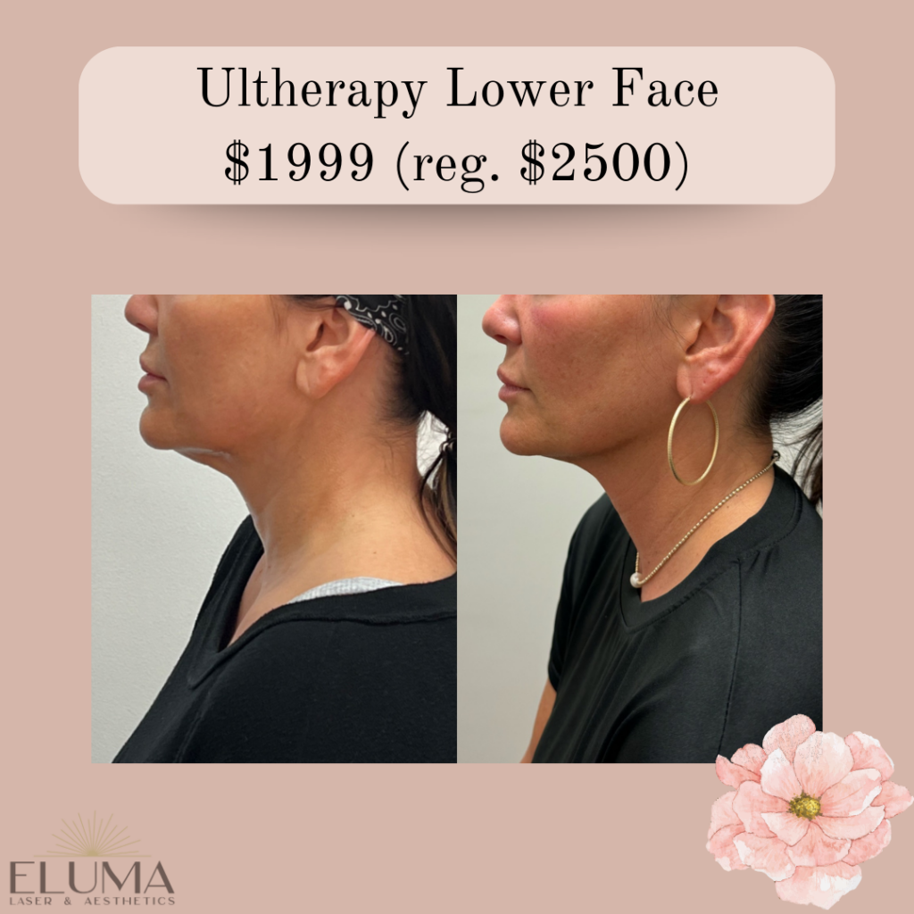 May Specials Ultherapy Eluma Laser and Aesthetics - Eluma - Laser & Aesthetics