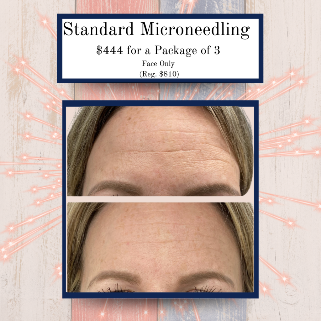July '25 Specials 9 - Eluma - Laser & Aesthetics Eluma Laser and Aesthetics July Specials. Standard microneedling. Add on exosomes for ultimate skin rejuvenation