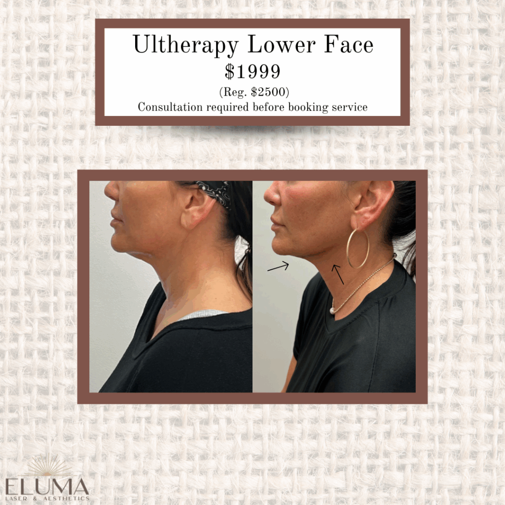 August Specials 7 - Eluma - Laser & Aesthetics
