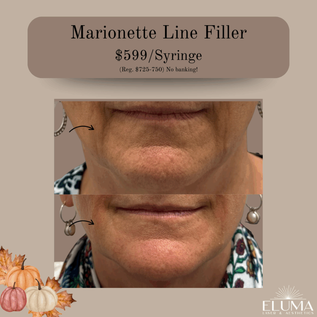 Eluma Laser and Aesthetics Nasolabial fold filler marionette line filler special - Eluma - Laser & Aesthetics