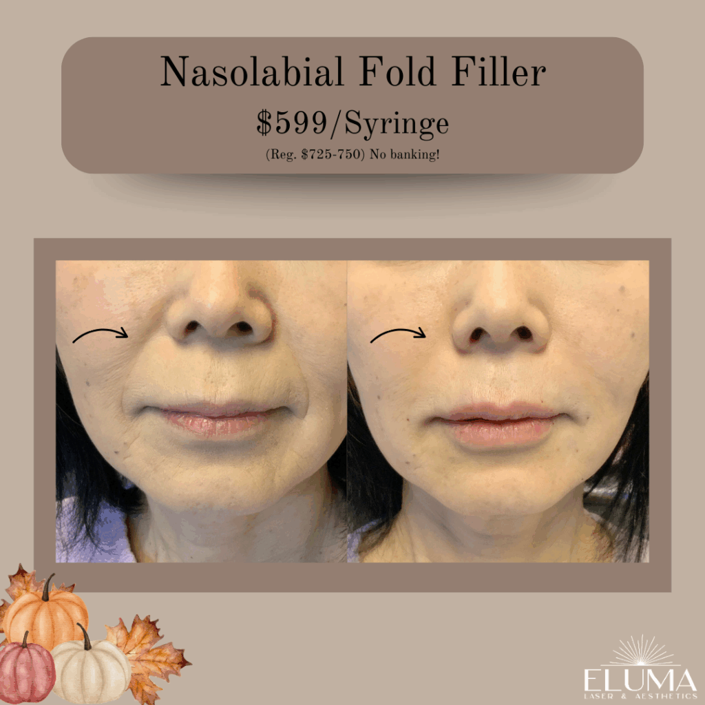 Eluma Laser and Aesthetics Nasolabial Fold filler special September - Eluma - Laser & Aesthetics