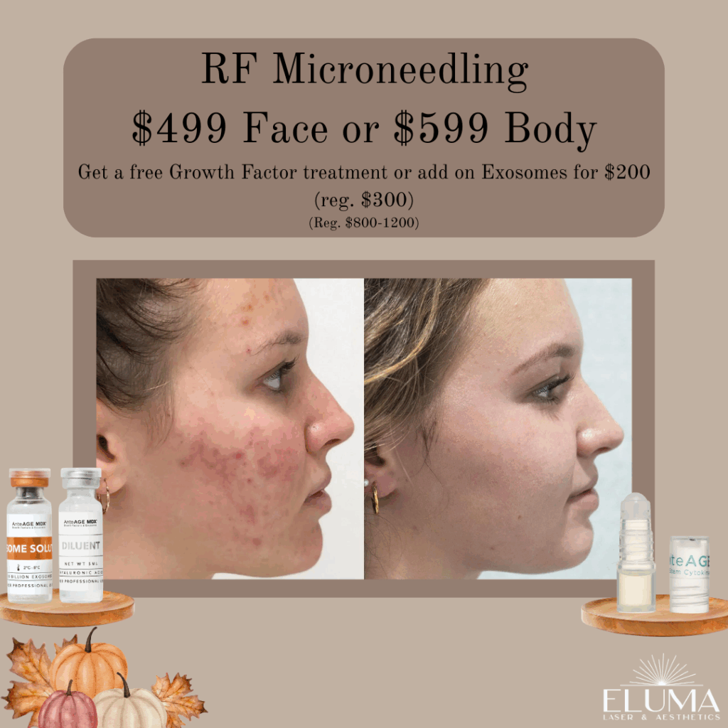 Eluma Laser and Aesthetics RF Microneedling Specials. Laser treatment for skin tightening, enlarged pores, wrinkle reduction and acne scaring. - Eluma - Laser & Aesthetics