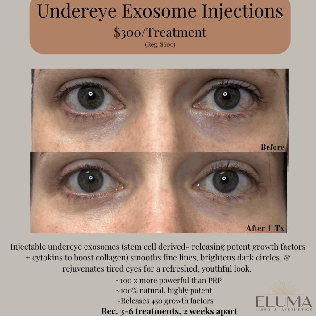 Eluma Laser and Aesthetics Exosome Undereye treatment - Eluma - Laser & Aesthetics