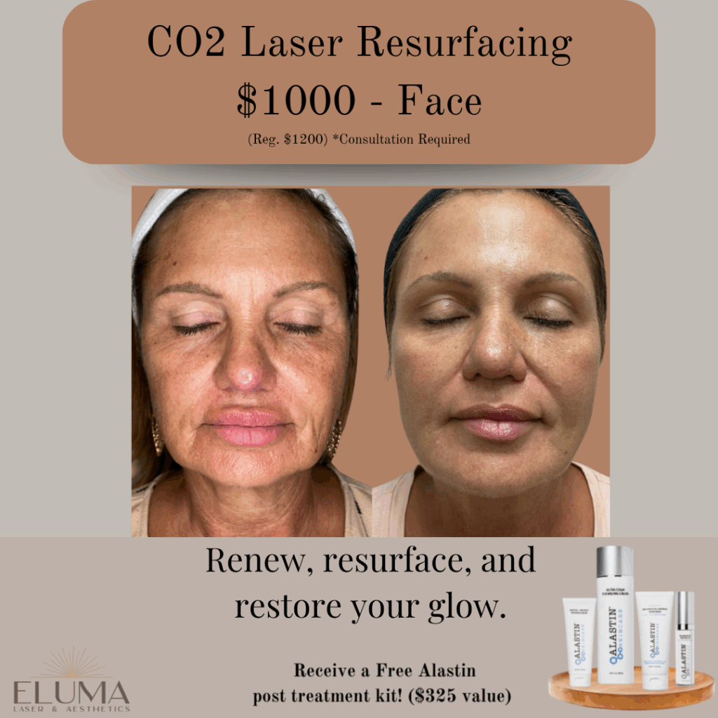 Eluma Laser and Aesthetics CO2 Laser resurfacing - Eluma - Laser & Aesthetics