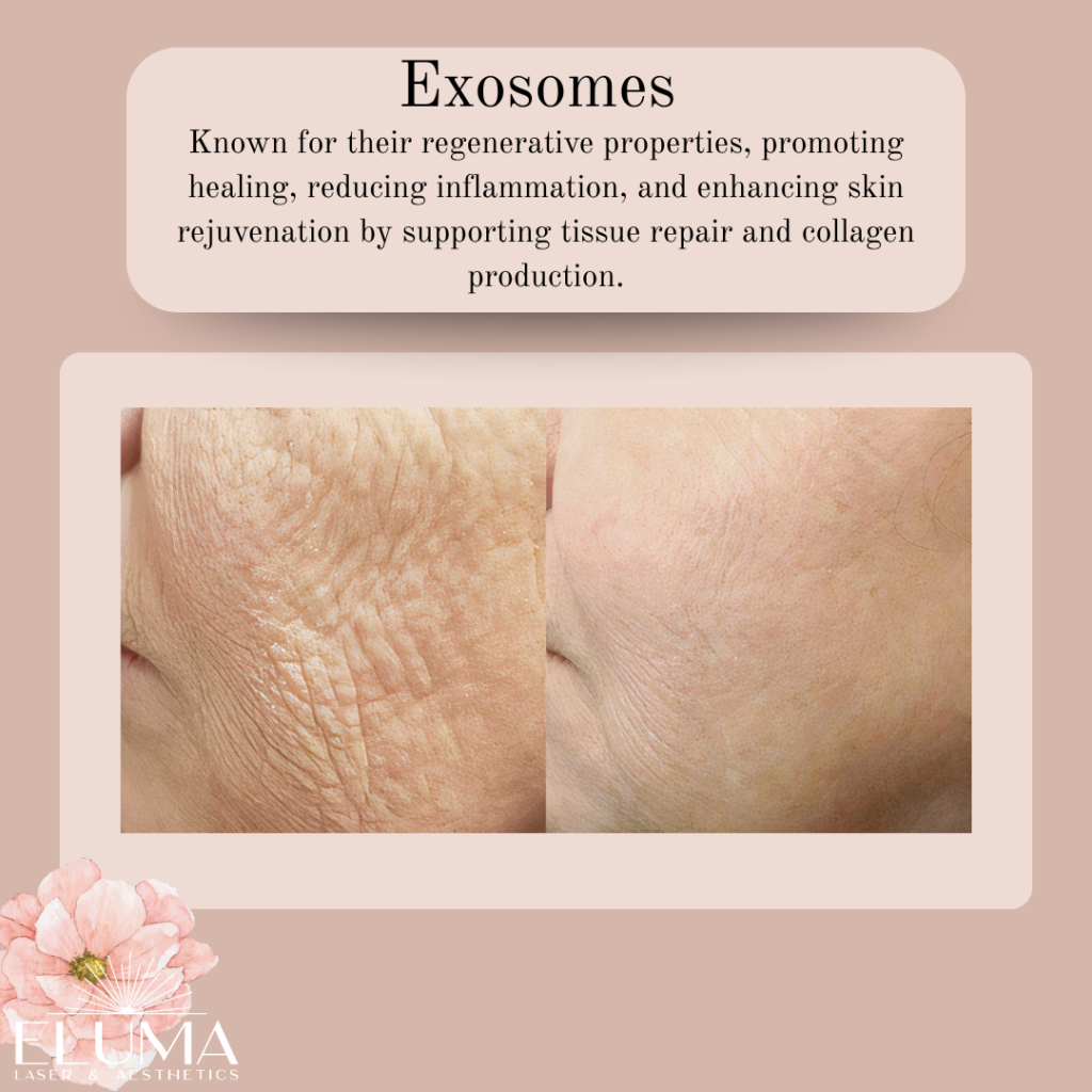 exosome info - Eluma - Laser & Aesthetics Before-and-after: left side wrinkled, aged-looking skin; right side smoother, rejuvenated skin illustrating exosome skin benefits.