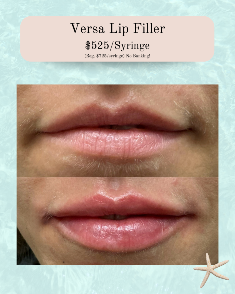 Advertisement for Versa Lip Filler: side‑by‑side close‑ups of lips before (top) and after (bottom) filler, showing fuller lips; price listed as $525 per syringe.
