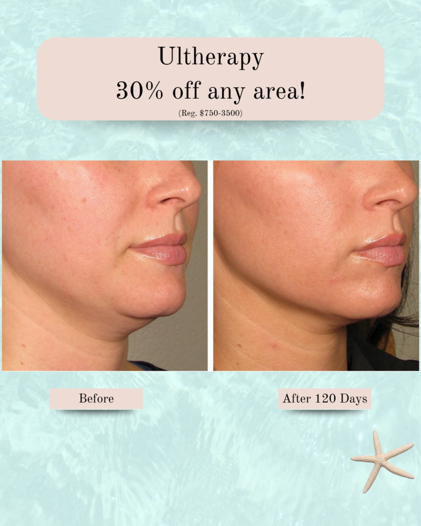 Promo banner for Ultherapy: 30% off any area; before and after photos of lower face and neck.