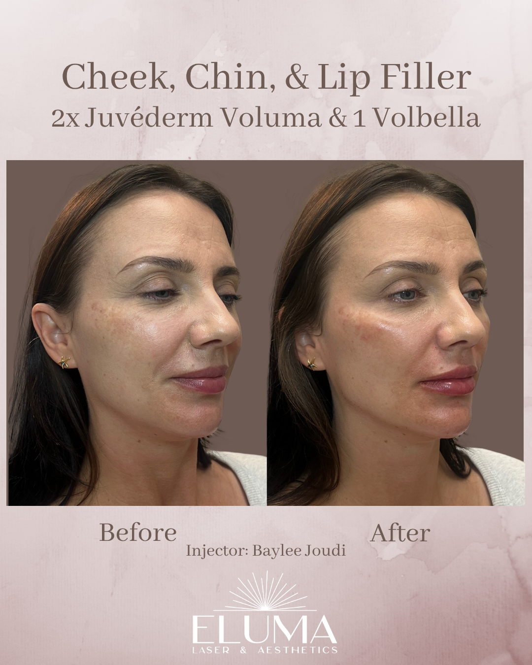 Before and after photos of a woman showing cheek, chin, and lip filler results with Juvederm Voluma and Volbella (clinic ad).