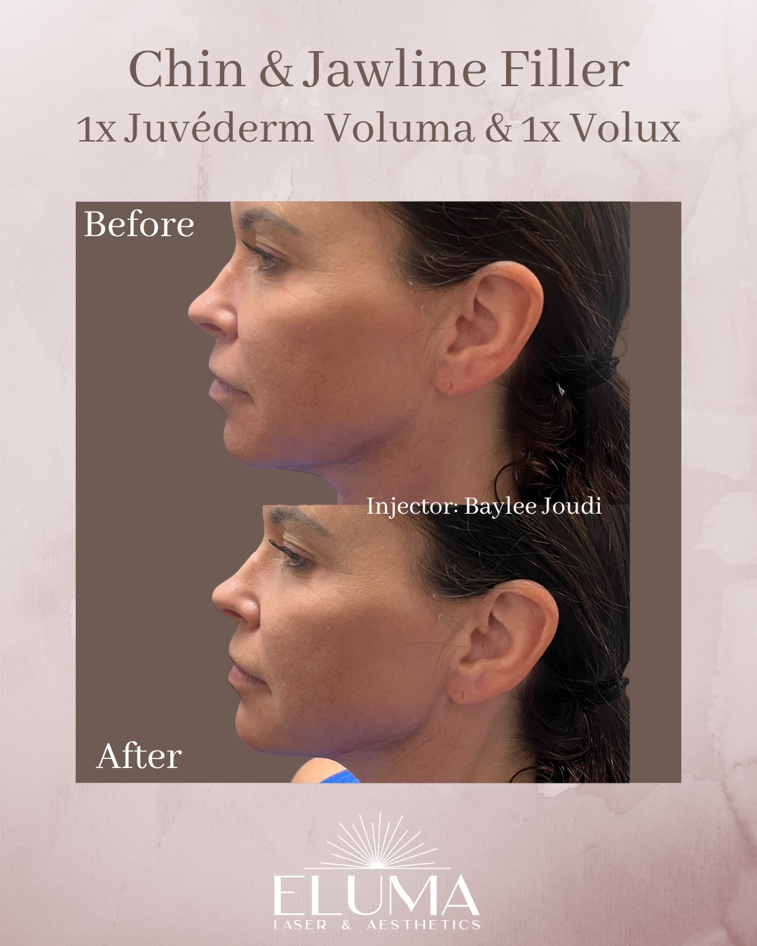 Side-profile before-and-after comparison of chin and jawline filler by Baylee Joudi at Eluma Laser & Aesthetics.