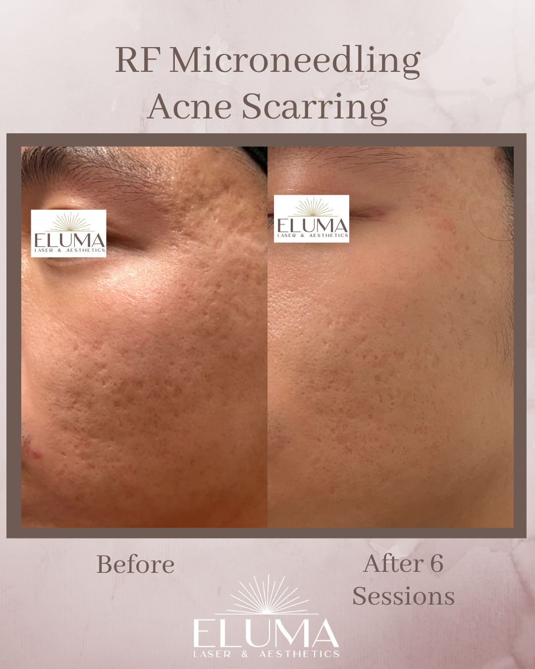 Side-by-side comparison of facial skin before and after 6 RF microneedling sessions, showing reduced acne scarring (ELUMA logo overlays).