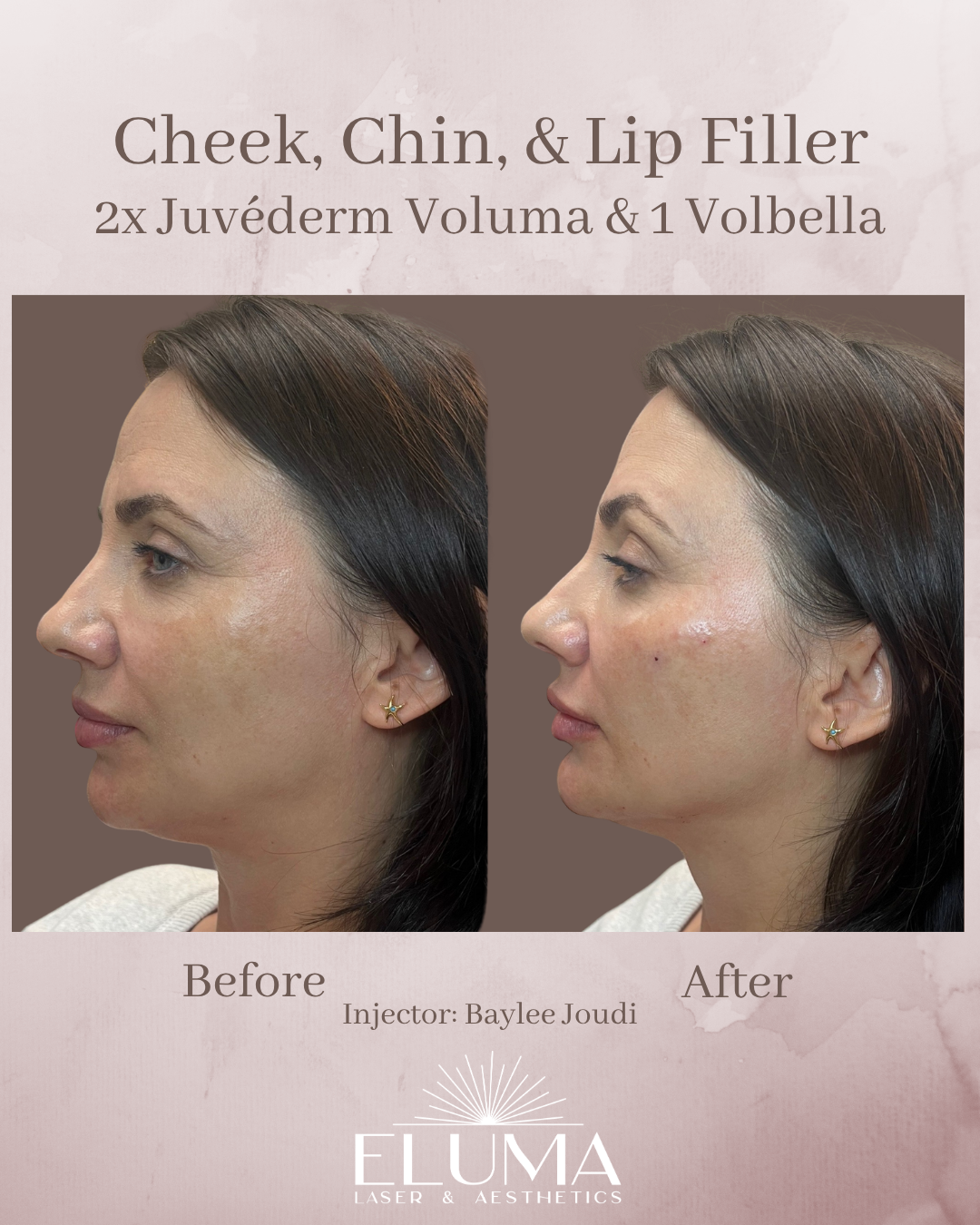 Before-and-after profile photos of a woman showing cheek, chin, and lip filler results from Juvederm Voluma and Volbella treatments.