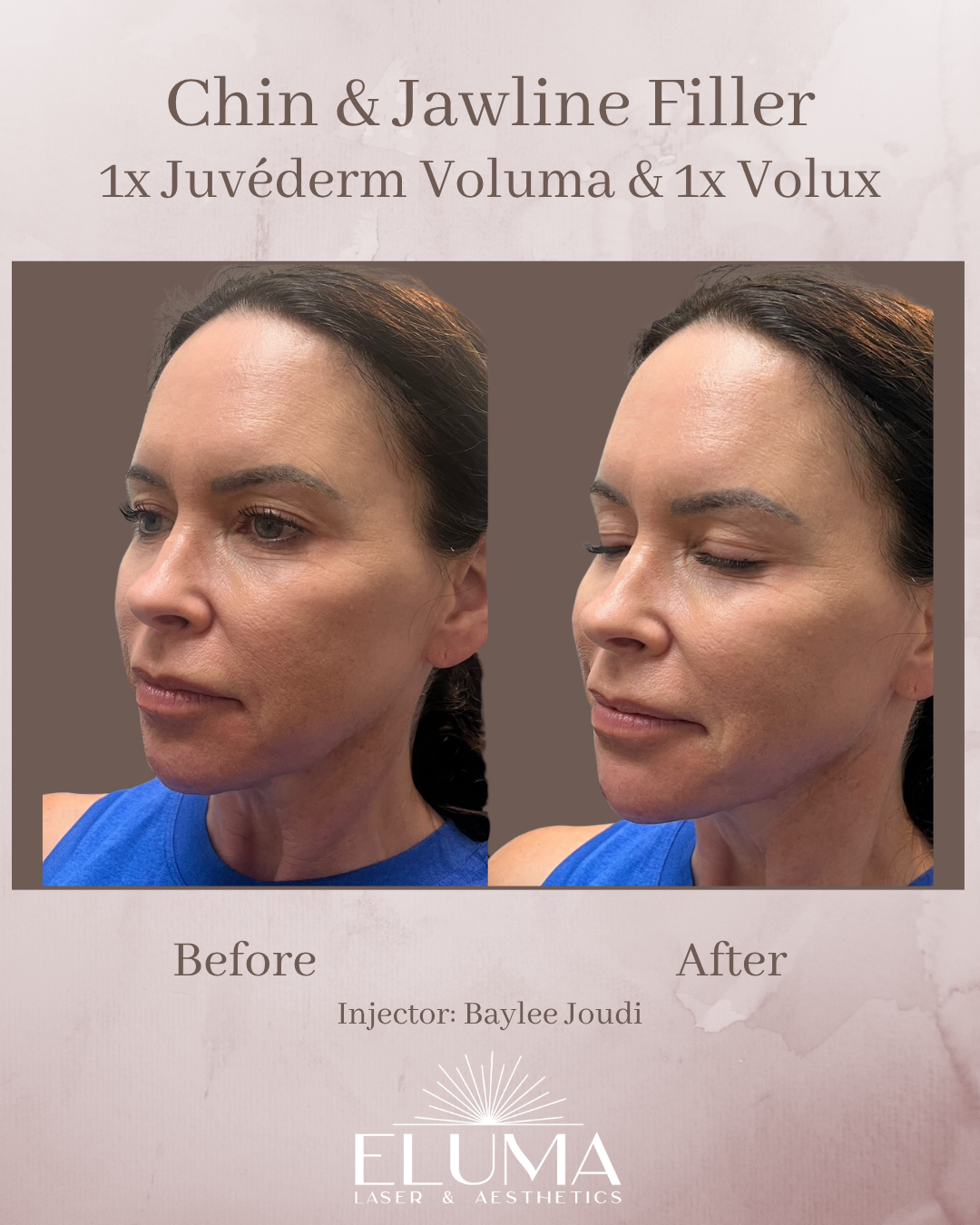 Before and after photos showing a fuller chin and defined jawline after dermal fillers (Juvederm Voluma & Volux) by Baylee Joudi at ELUMA Laser & Aesthetics with a side-by-side layout on a soft pink background.