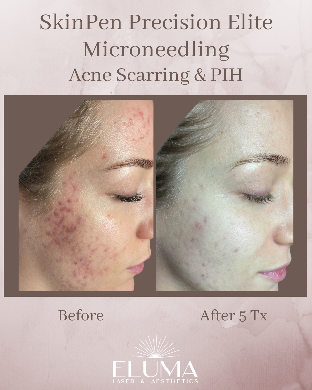 Side-by-side close-up of a woman's cheek before and after five microneedling treatments for acne scars and PIH (SkinPen).