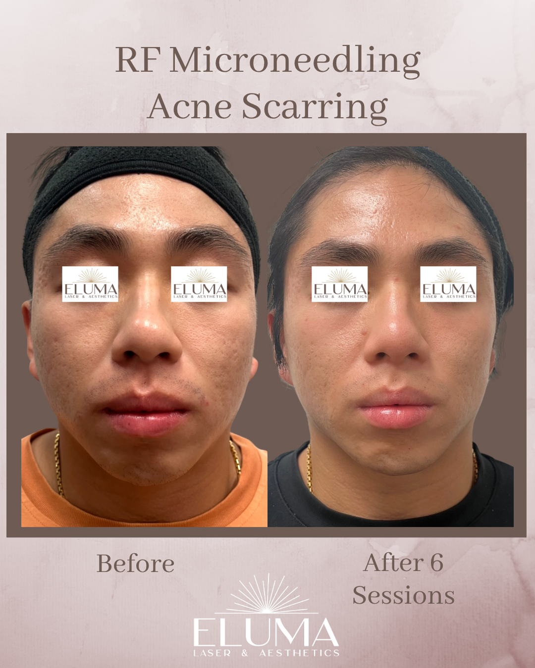 Before and after RF microneedling for acne scarring: left shows initial complexion with visible pores, right shows improved texture after 6 sessions with Eluma Laser & Aesthetics branding.