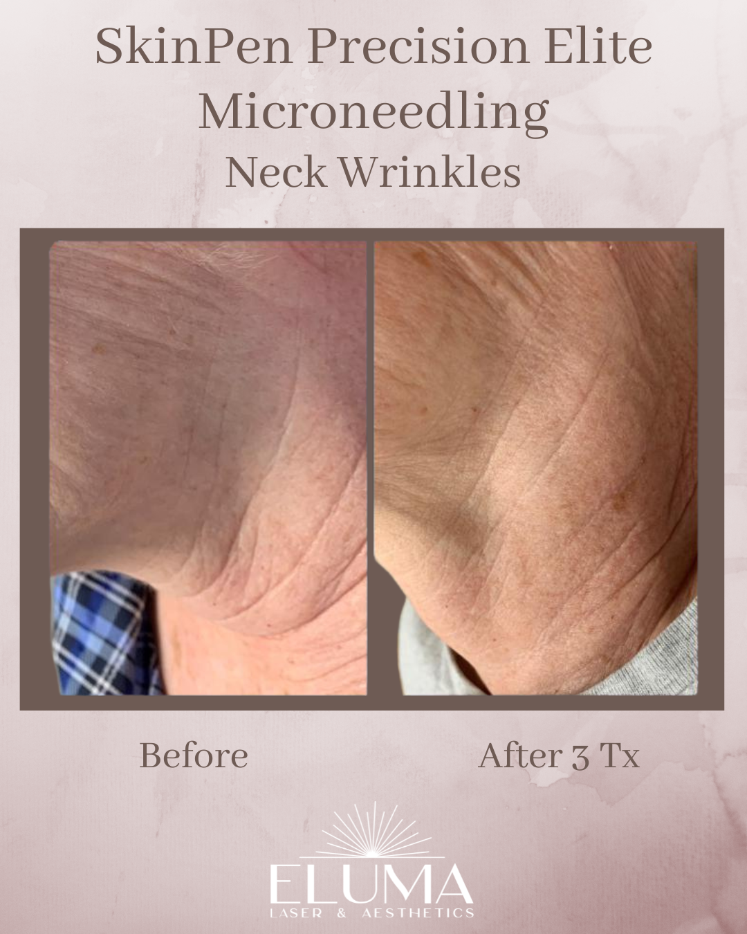 Before/After neck microneedling comparison showing reduced wrinkles after 3 treatments; brand ELUMA at bottom.