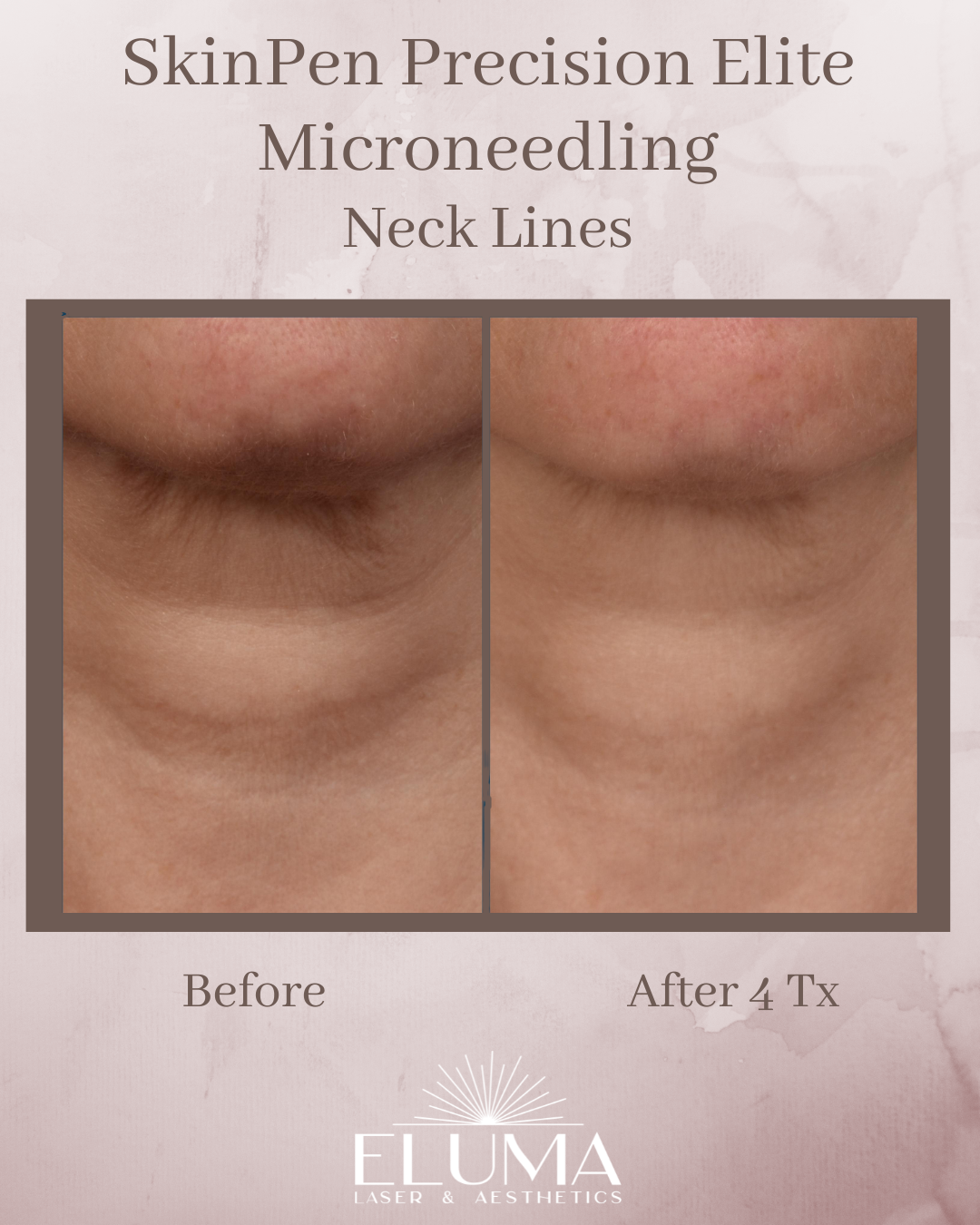 Side-by-side close-ups of neck before and after four microneedling treatments, showing smoother skin and fewer lines.