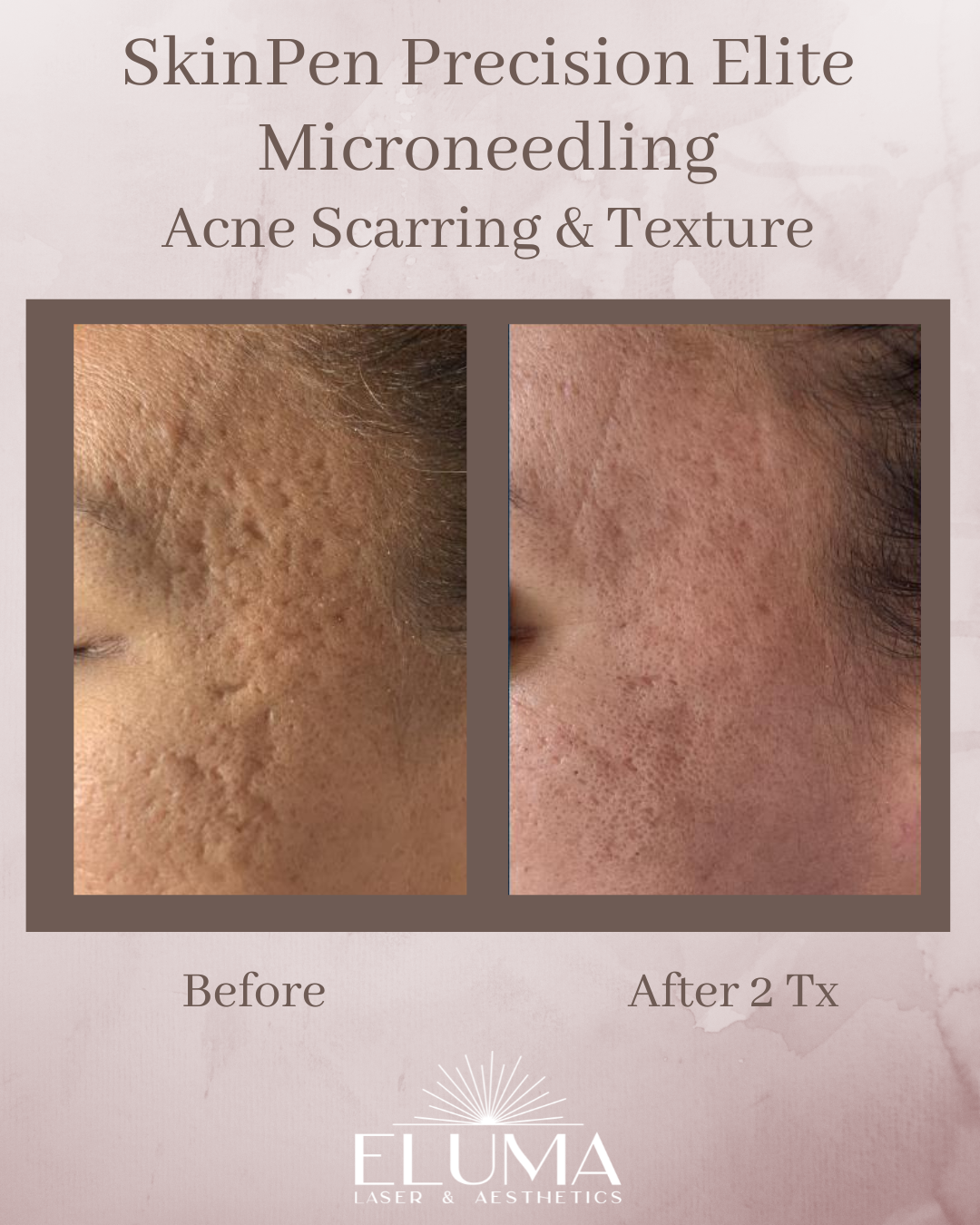 Before-and-after collage of cheek skin showing acne scar improvement after microneedling; left with pitted scars, right smoother skin.