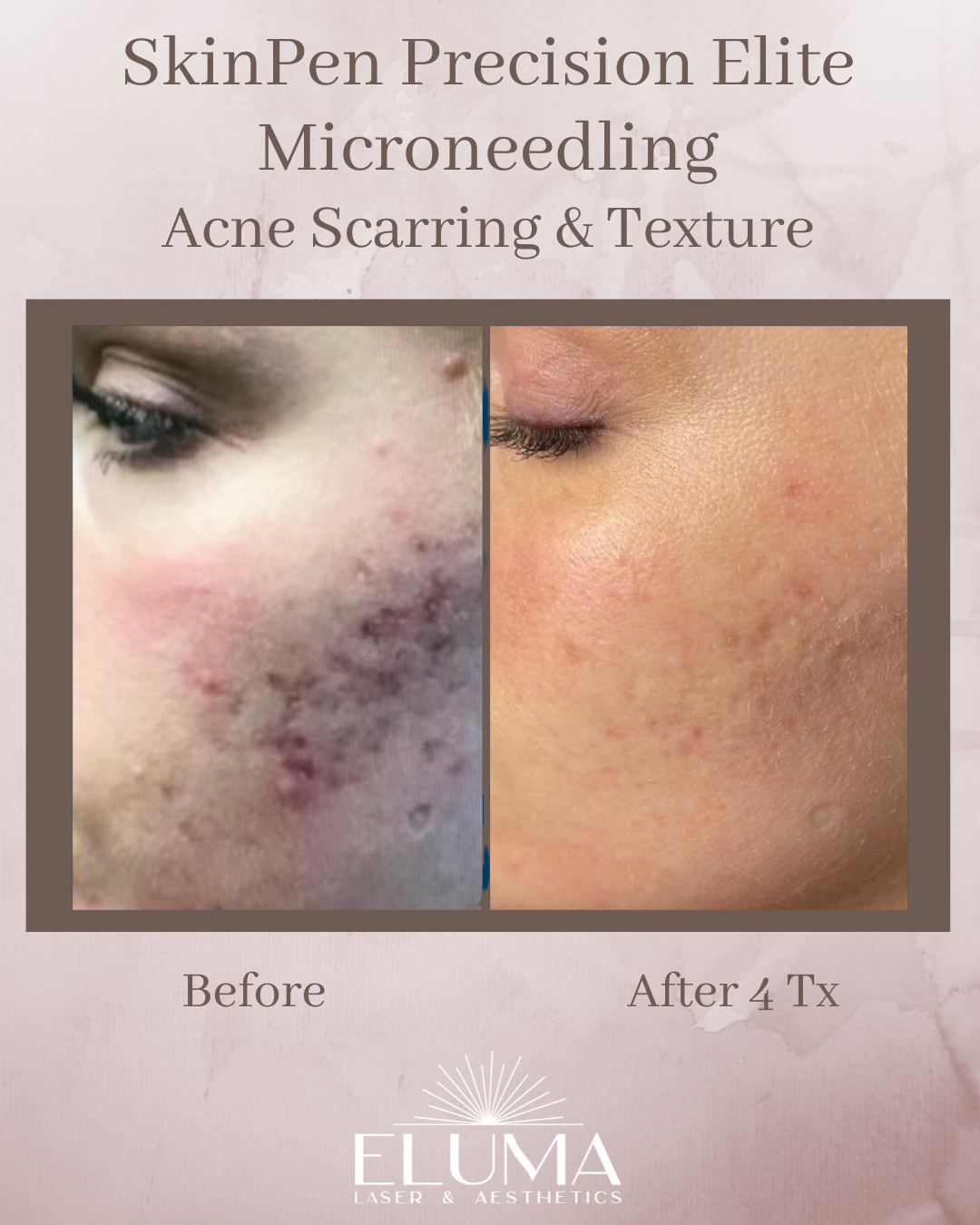 Side-by-side before-and-after collage: left shows inflamed acne scars on the cheek; right shows smoother skin after 4 SkinPen microneedling treatments by Eluma Laser & Aesthetics