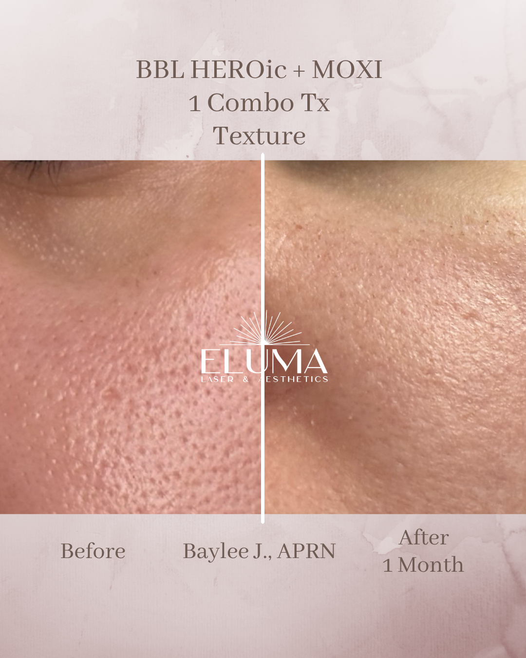 Before and after close-up of facial skin showing pore reduction and smoother texture after BBL HERO + MOXI treatment (1 month).