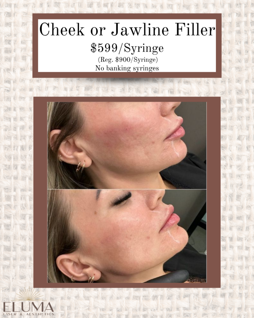 cheek jawline 4 - Eluma - Laser & Aesthetics Advertisement for cheek or jawline filler at $599 per syringe, showing before and after images of a woman's lower face with improved cheek and jawline definition. Logo: EL UMA Laser & Aesthetics.