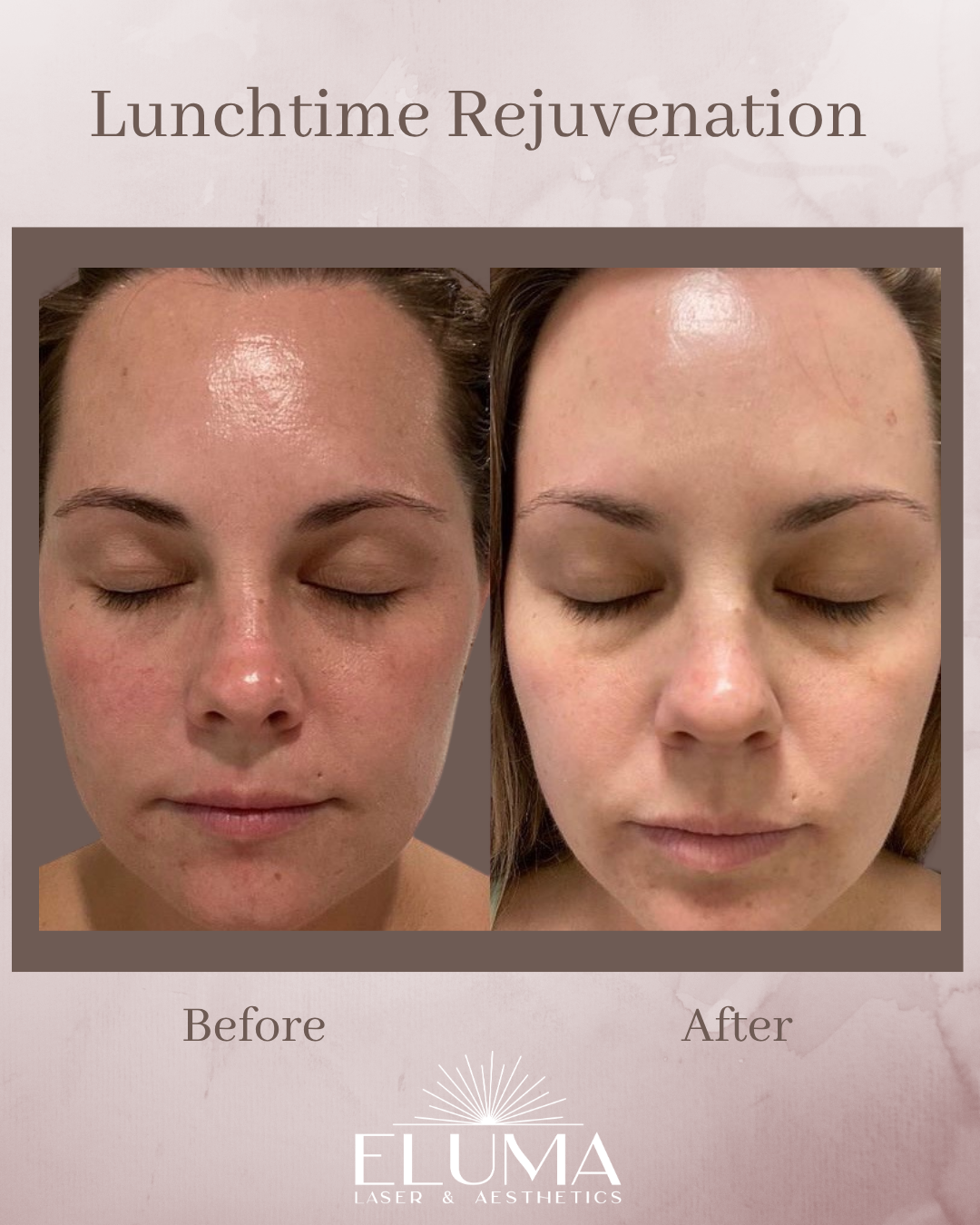 Before-and-after montage: left side with red, slightly flushed skin; right side clearer, smoother skin after Lunchtime Rejuvenation, eyes closed.