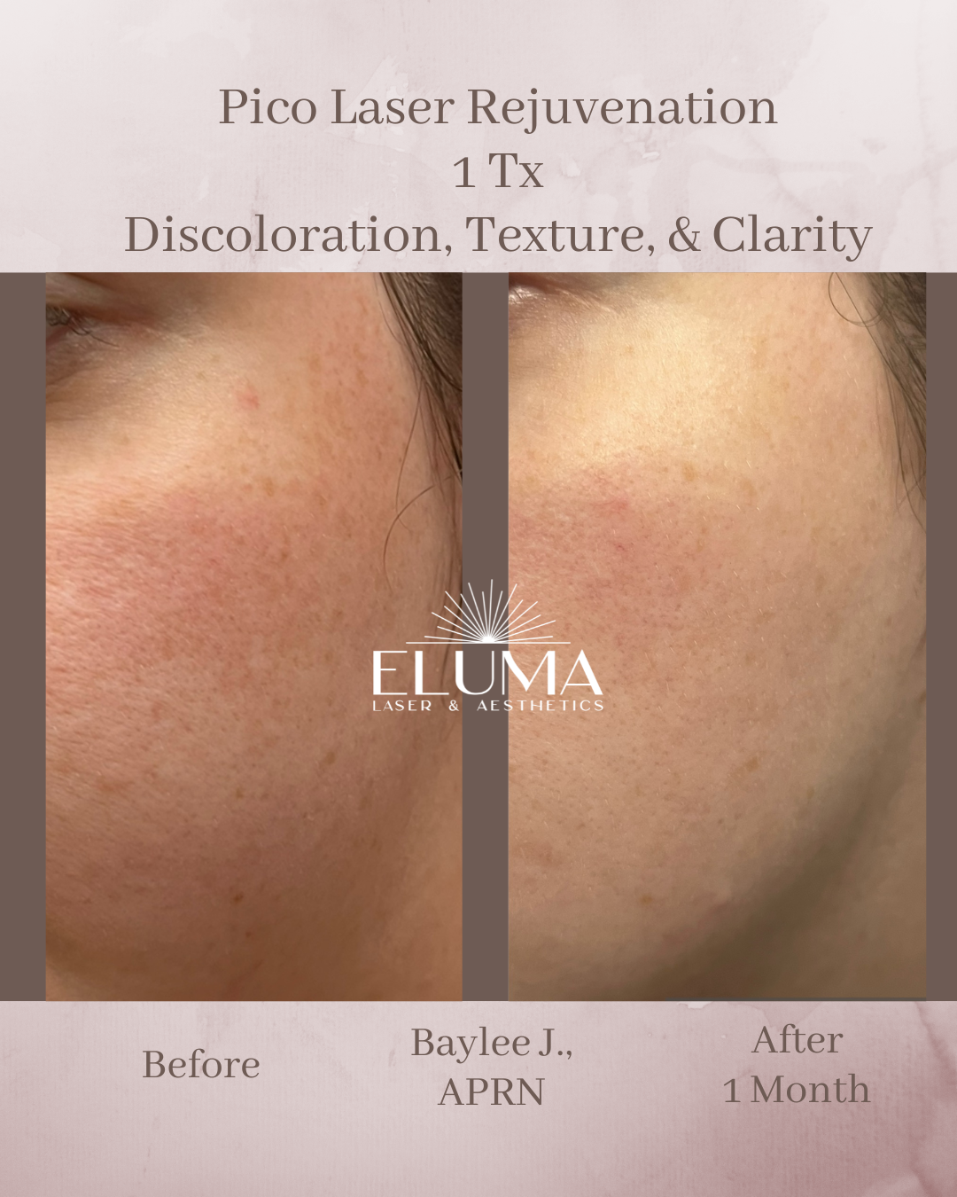 Side-by-side before and after comparison of facial skin: left shows discoloration and uneven texture; right shows improved tone and smoother skin, labeled 'Before' and 'After 1 Month' with ELUMA Laser & Aesthetics logo between.