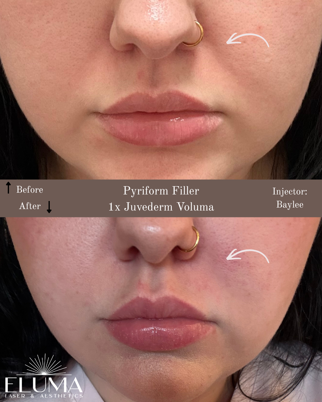 Before and after images showing pyriform filler with Juvederm Voluma on the cheek, injected by Baylee.