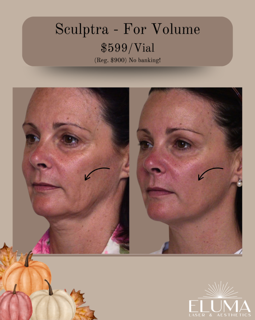 sculptra 6 - Eluma - Laser & Aesthetics