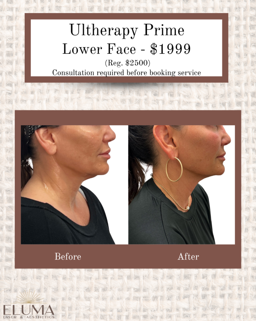 ultherapy 6 - Eluma - Laser & Aesthetics