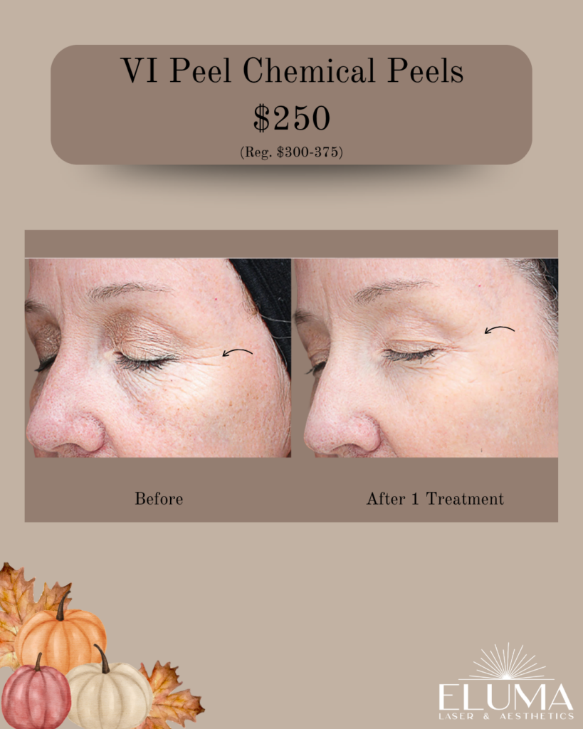 vi 9 - Eluma - Laser & Aesthetics Promotional banner for VI Peel Chemical Peels at $250, showing before and after eye-area results with fall-themed background and ELUMA Laser & Aesthetics logo.