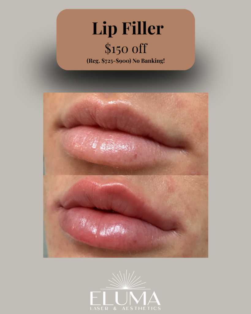 Promotional graphic for lip filler offer ($150 off) by ELUMA Laser & Aesthetics, with before-and-after lip photos.