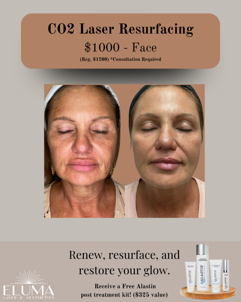Promotional image for CO2 laser resurfacing: before-and-after photos, $1000 per face with consultation required, from Eluma Laser & Aesthetics.