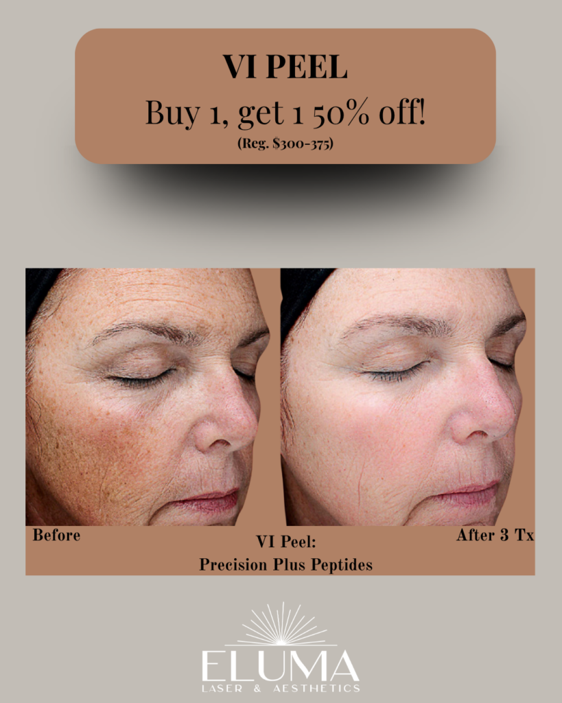 Promotional VI Peel with before/after photos showing smoother, lighter skin after 3 treatments; Eluma Laser & Aesthetics.
