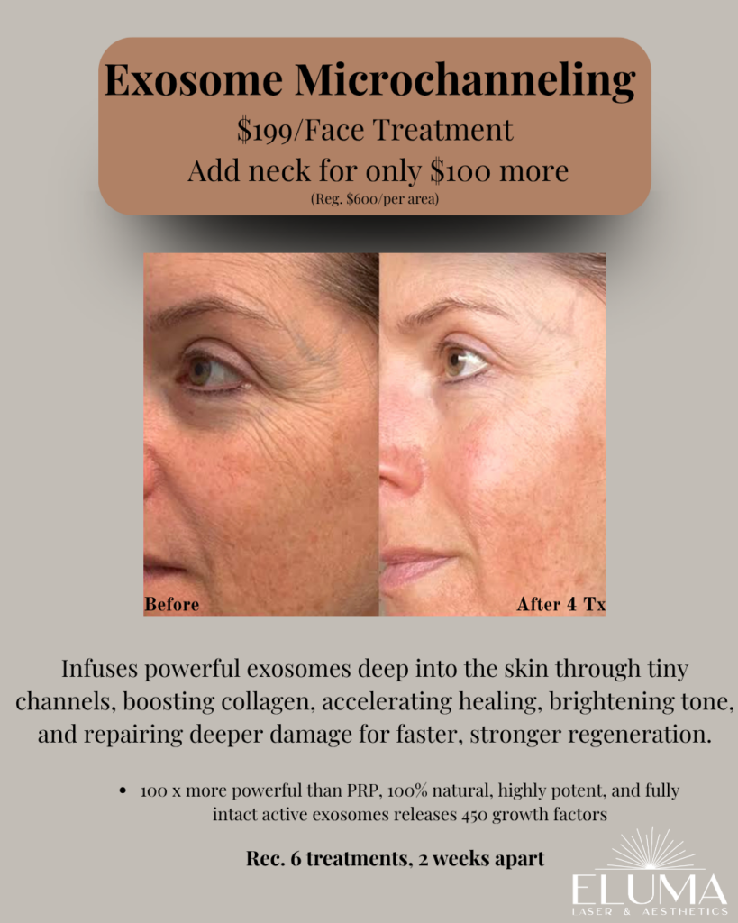 Advertisement for Exosome Microchanneling showing a side-by-side before-and-after facial photo with pricing and 'After 4 Tx' label and logo; describes treatment offer and benefits.